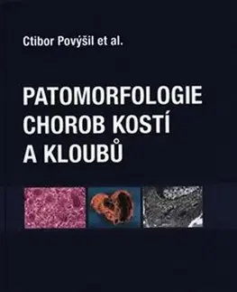 Medicína - ostatné Patomorfologie chorob kostí a kloubů - Ctibor Povýšil