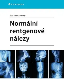 Medicína - ostatné Normální rentgenové nálezy - Torsten B. Möller