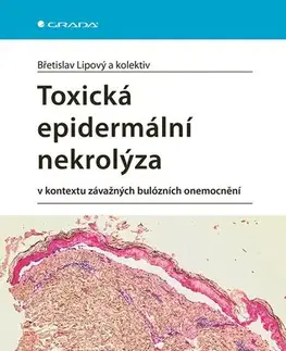 Medicína - ostatné Toxická epidermální nekrolýza - Břetislav Lipový,Kolektív autorov