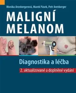 Medicína - ostatné Maligní melanom: Diagnostika a léčba, 2. vydání