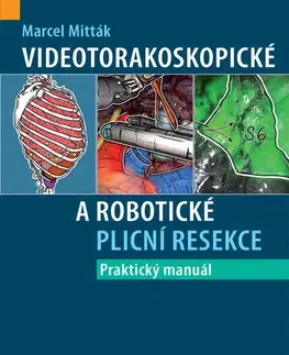 Chirurgia, ortopédia, traumatológia Videotorakoskopické a robotické plicní resekce - Praktický manuál - Marcel Mitták