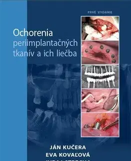 Medicína - ostatné Ochorenia periimplantačných tkanív a ich liečba - Jan Kučera,Eva Kovaľová