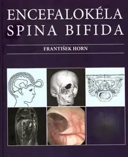 Medicína - ostatné Encefalokéla spina bifida - František Horn