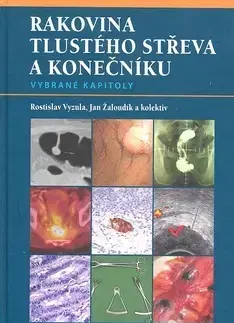 Medicína - ostatné Rakovina tlustého střeva a konečníku - Rostislav Vyzula