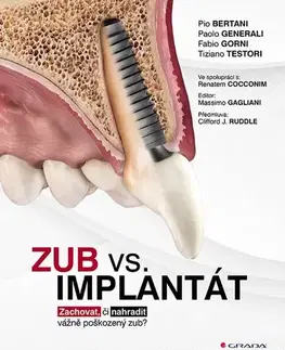 Stomatológia Zub vs. implantát - Kolektív autorov