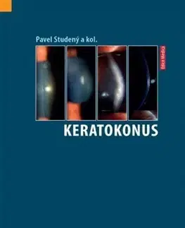 Medicína - ostatné Keratokonus - Pavel Studený,Kolektív autorov