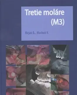 Stomatológia Tretie moláre (M3) - Vladimír Machoň,Dušan Hirjak