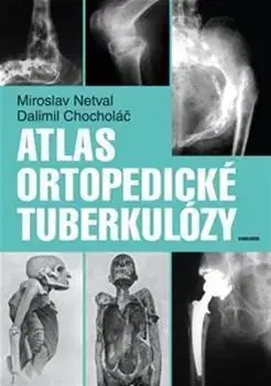 Medicína - ostatné Atlas ortopedické tuberkulózy - Dalimil Chocholac
