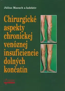 Medicína - ostatné Chirurgické aspekty chronickej venóznej insuficiencie dolných končatín - Július Mazúch