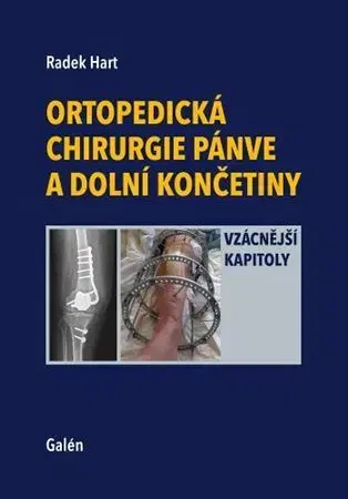 Chirurgia, ortopédia, traumatológia Ortopedická chirurgie pánve a dolní končetiny - Radek Hart