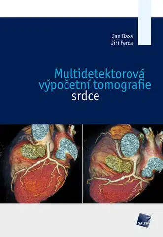 Medicína - ostatné Multidetektorová výpočetní tomografie srdce - Jan Baxa,Jiří Ferda