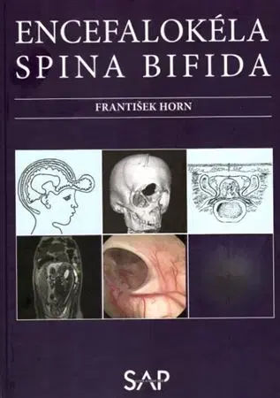 Medicína - ostatné Encefalokéla spina bifida - František Horn