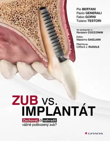 Stomatológia Zub vs. implantát - Kolektív autorov