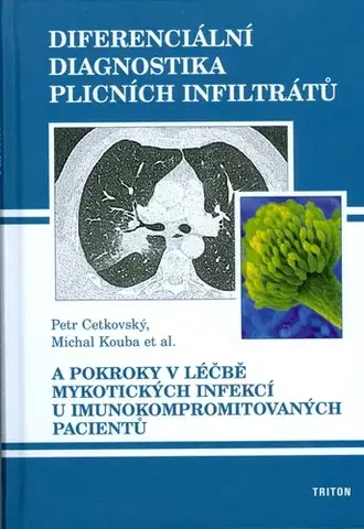 Medicína - ostatné Diferenciální diagnostika plicních infiltrátů - Petr Cetkovský