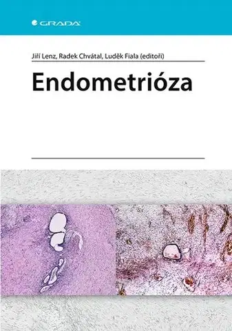 Medicína - ostatné Endometrióza - Jiří Lenz,Radek Chvátal,Luděk Fiala