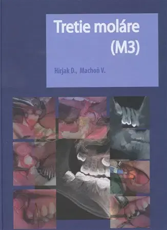 Stomatológia Tretie moláre (M3) - Vladimír Machoň,Dušan Hirjak