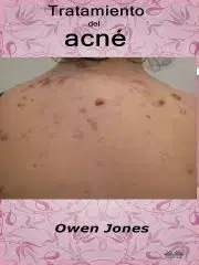Zdravie, životný štýl - ostatné Tratamiento Del Acné - Owen Jones